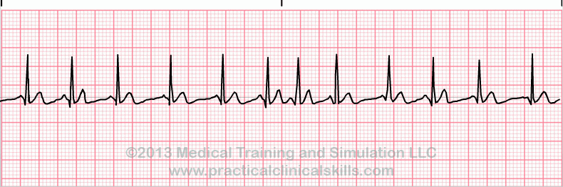 Multifocal Atrial Tachycardia EKG tracing