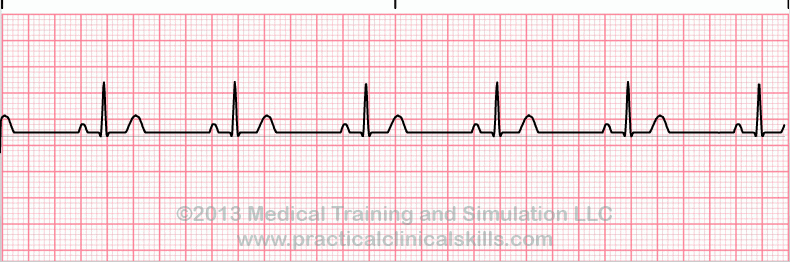 ecg rhythm strip for quiz