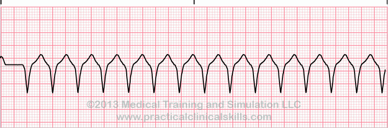 Ventricular Tachycardia EKG tracing