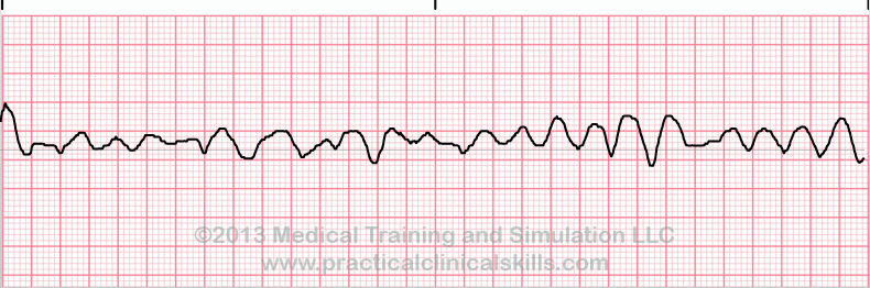 ecg rhythm strip for quiz