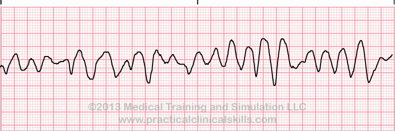 ecg rhythm strip for quiz
