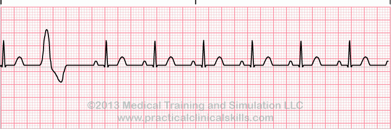 ecg rhythm strip for quiz