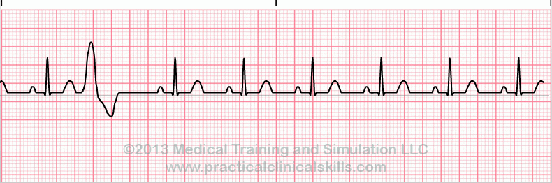 Essential EKGs for Nurses | Multiple Choice Graded Quiz