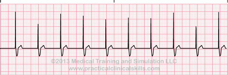 ecg rhythm strip for quiz