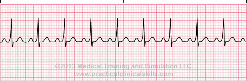  rhythm EKG tracing