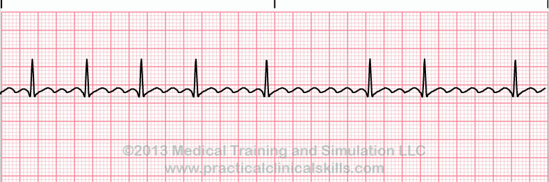 EKG le tracé - Exercices Entrainement ECG