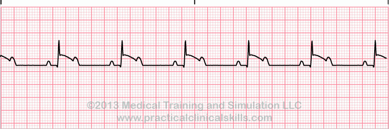 ecg rhythm strip for quiz