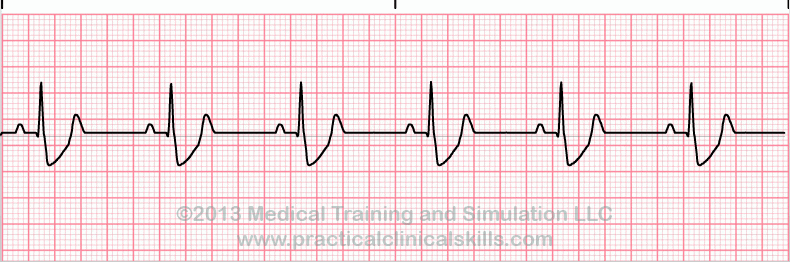 ecg rhythm strip for quiz