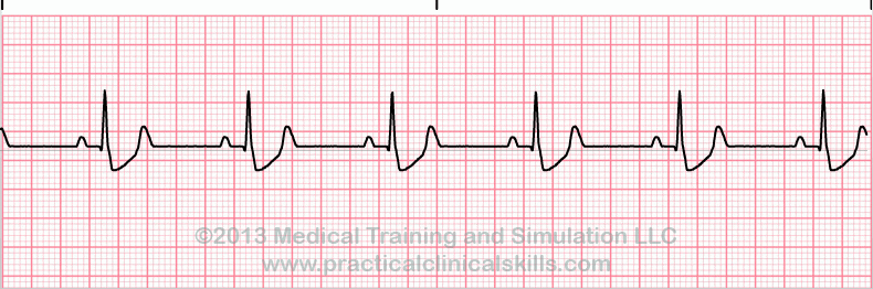 ecg rhythm strip for quiz