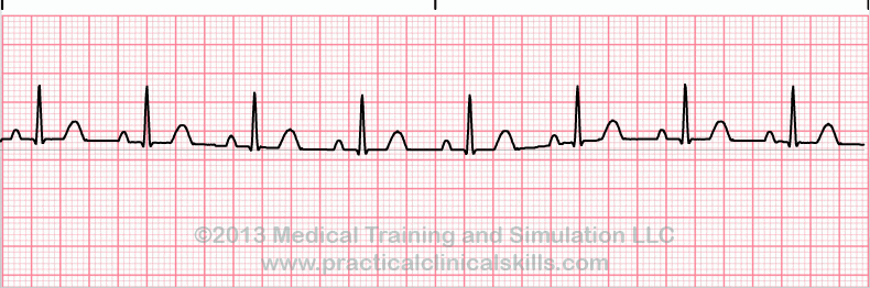 ecg rhythm strip for quiz