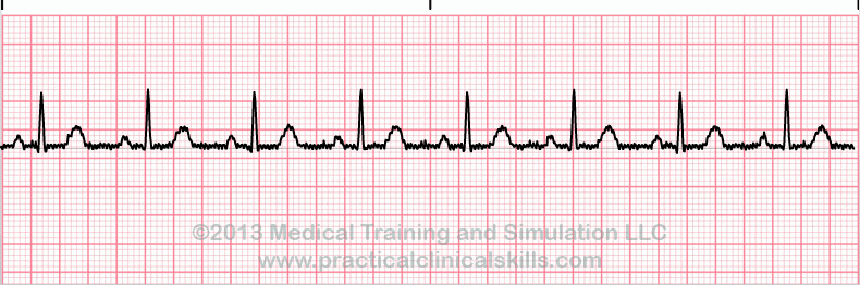 ecg rhythm strip for quiz