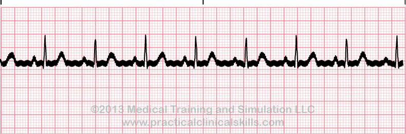 ecg rhythm strip for quiz