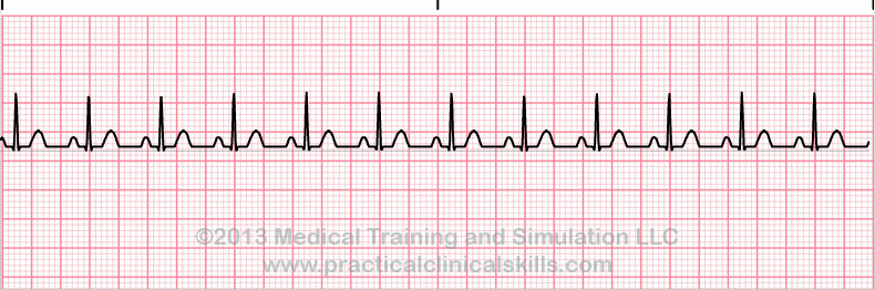 ecg rhythm strip for quiz