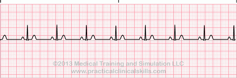 EKG - Identifizieren Sie die Aufzeichnung