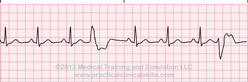 Premature Ventricular Complex - Quadrigeminy EKG tracing