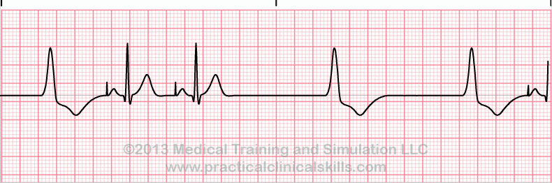 Failure to Pace EKG tracing
