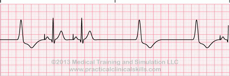 ekg rhythm strip for reference guide