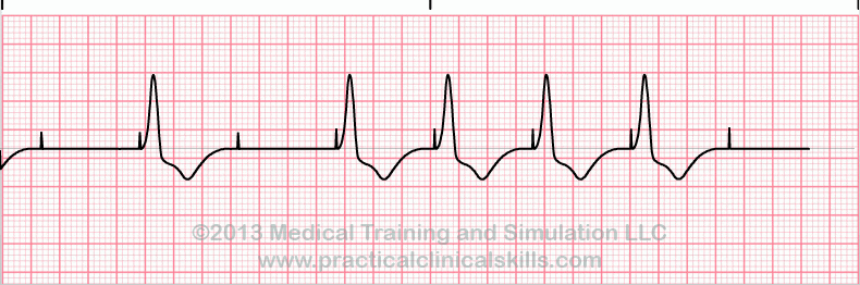 ecg rhythm strip for quiz