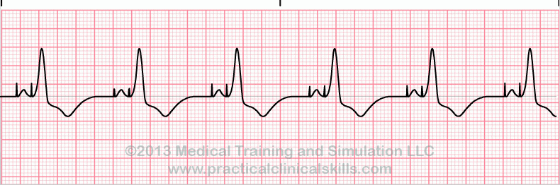 ecg rhythm strip for quiz