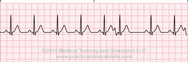 ecg rhythm strip for quiz