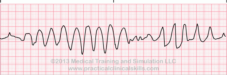 ecg rhythm strip for quiz