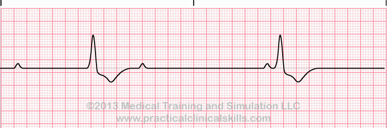 ecg rhythm strip for quiz