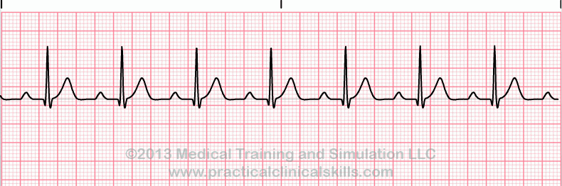 First Degree Heart Block EKG tracing