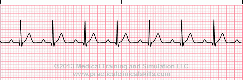 ecg rhythm strip for reference guide