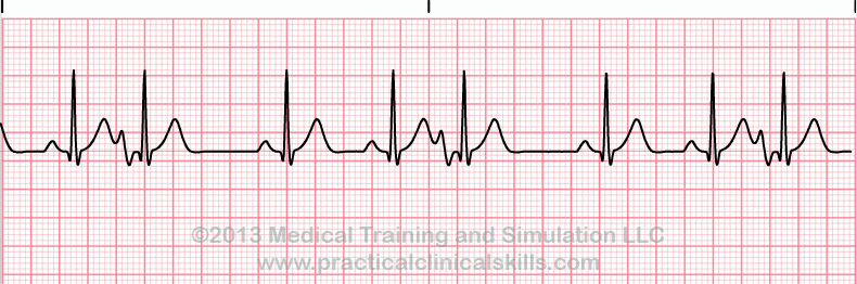 ecg rhythm strip for quiz