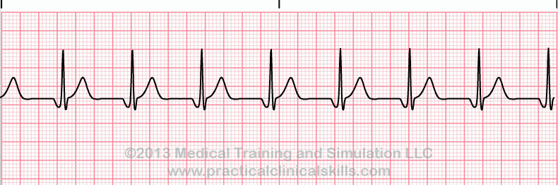 EKG le tracé - Exercices Entrainement ECG