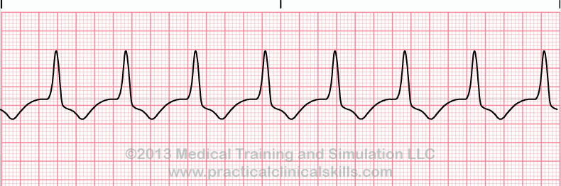 Accelerated Idioventricular Rhythm EKG tracing