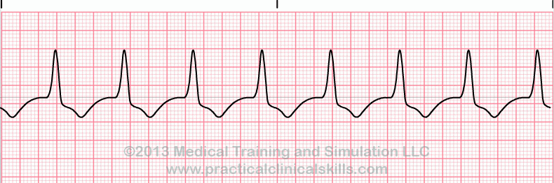 ecg rhythm strip for reference guide