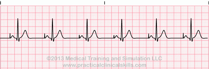 ecg rhythm strip for quiz