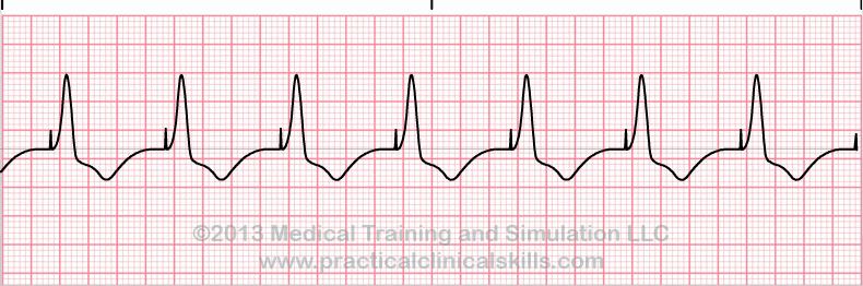 ecg rhythm strip for quiz