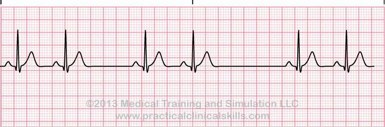 ecg rhythm strip for quiz