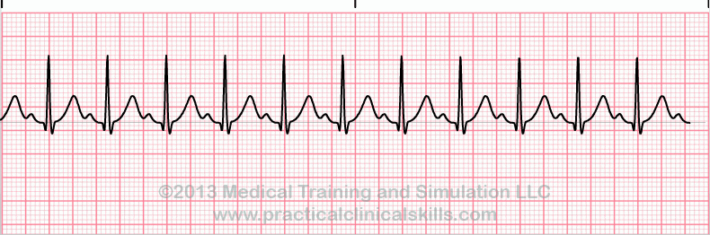 ecg rhythm strip for quiz