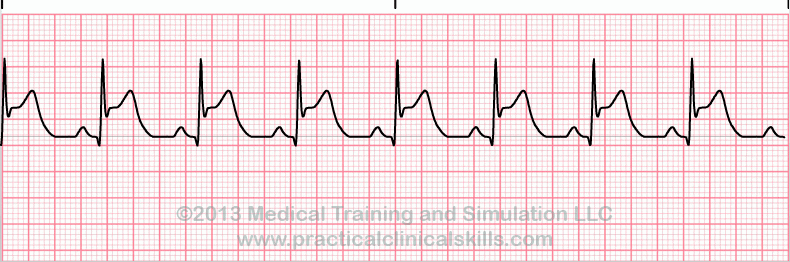 ecg rhythm strip for quiz