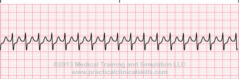 Supraventricular Tachycardia EKG tracing