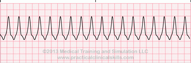 ecg rhythm strip for quiz