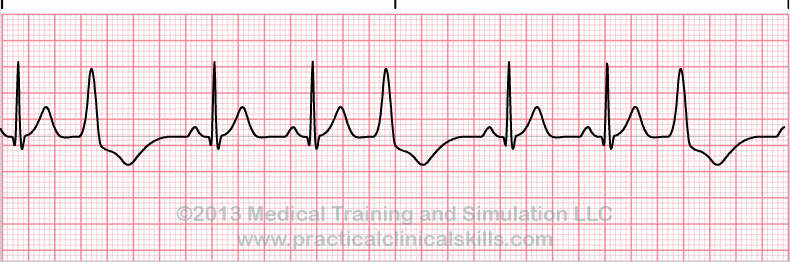 ecg rhythm strip for quiz
