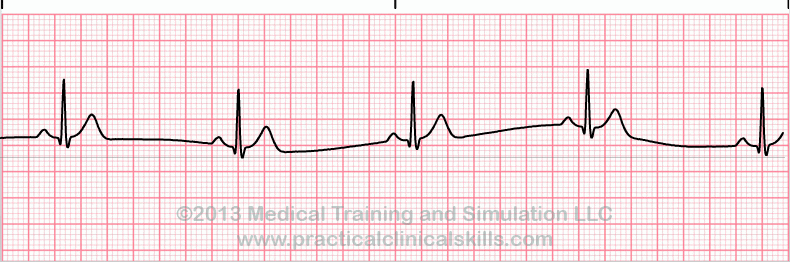 ecg rhythm strip for quiz