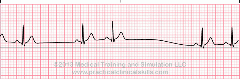ecg rhythm strip for quiz