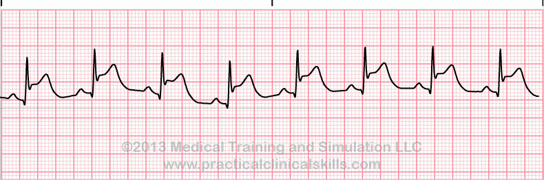 ecg rhythm strip for quiz