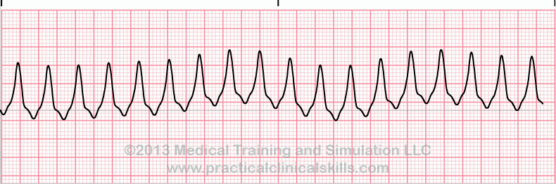 ecg rhythm strip for quiz
