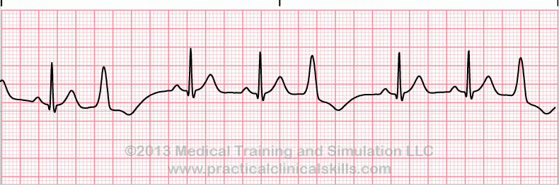 ecg rhythm strip for quiz