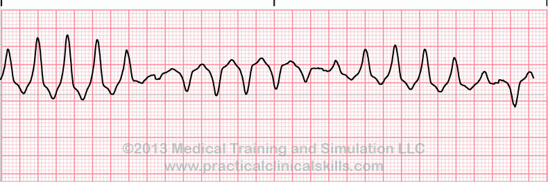 ecg rhythm strip for quiz