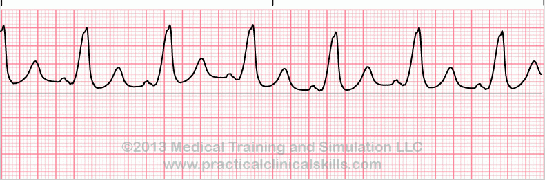 ecg rhythm strip for quiz