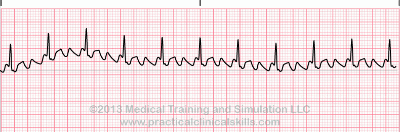ecg rhythm strip for quiz