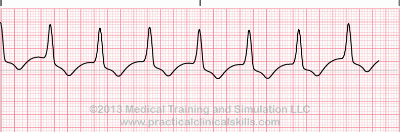 ecg rhythm strip for quiz