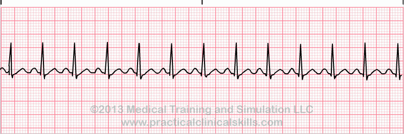 Sinus Tachycardia EKG tracing